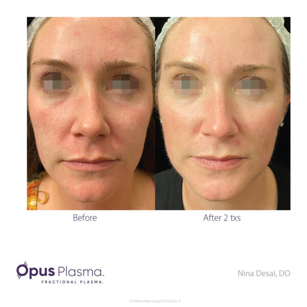 Fractional Resurfacing Laser Skin Resurfacing Treatment in Oakville