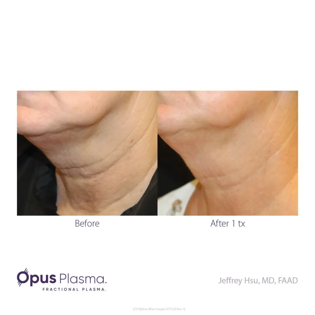 Opus-Before-and-After-B2C-3