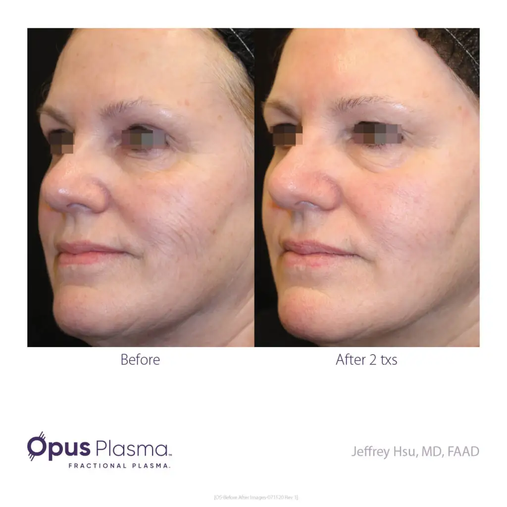Opus-Before-and-After-B2C-4