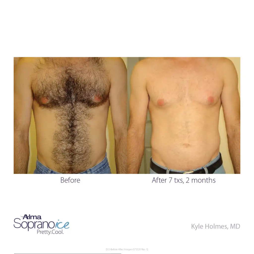 Soprano-ICE-Before-and-After-B2C-1-Hair-Removal-1