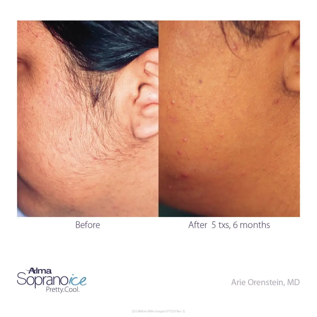 Soprano-ICE-Before-and-After-B2C-3-Hair-Removal