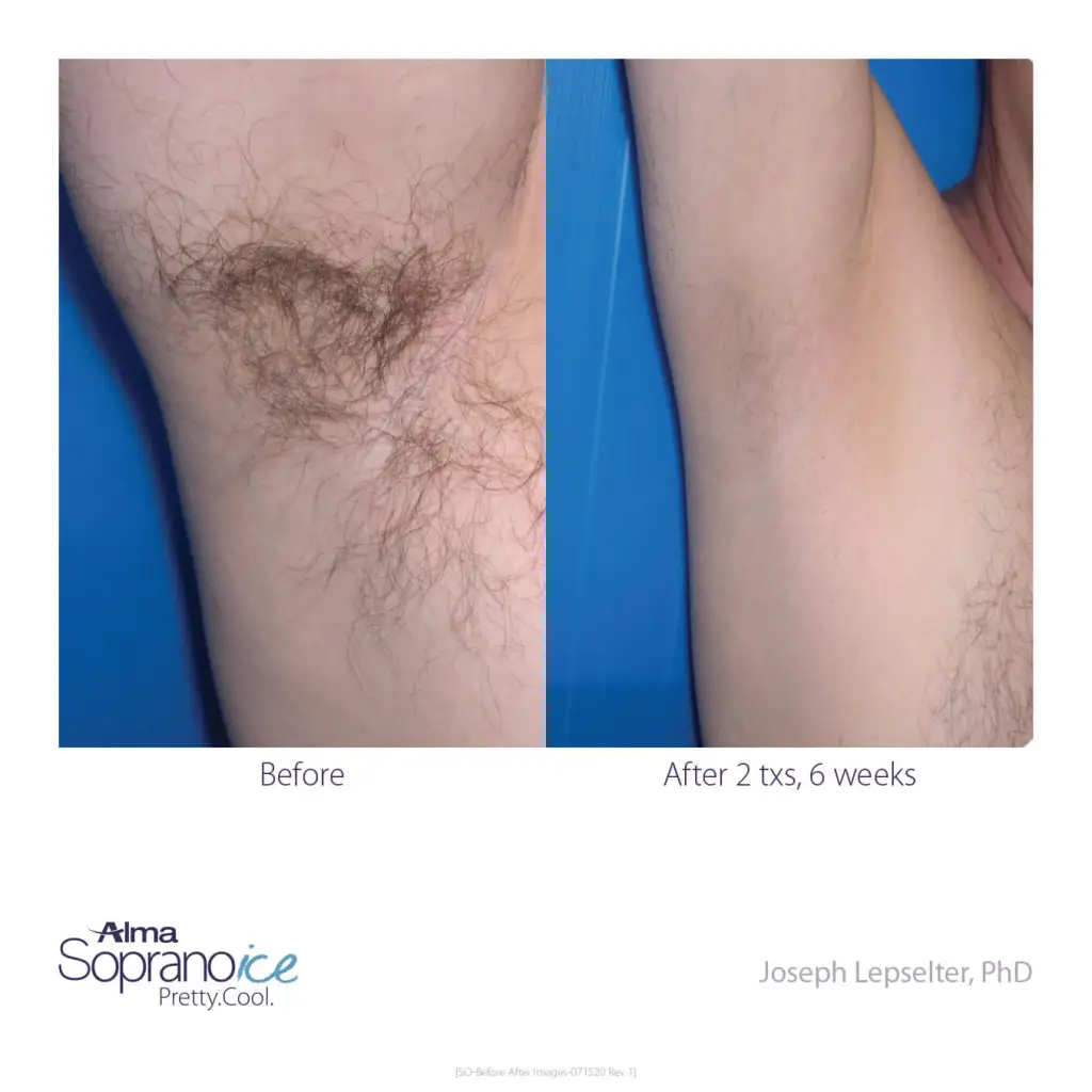 Soprano-ICE-Before-and-After-B2C-5-Hair-Removal