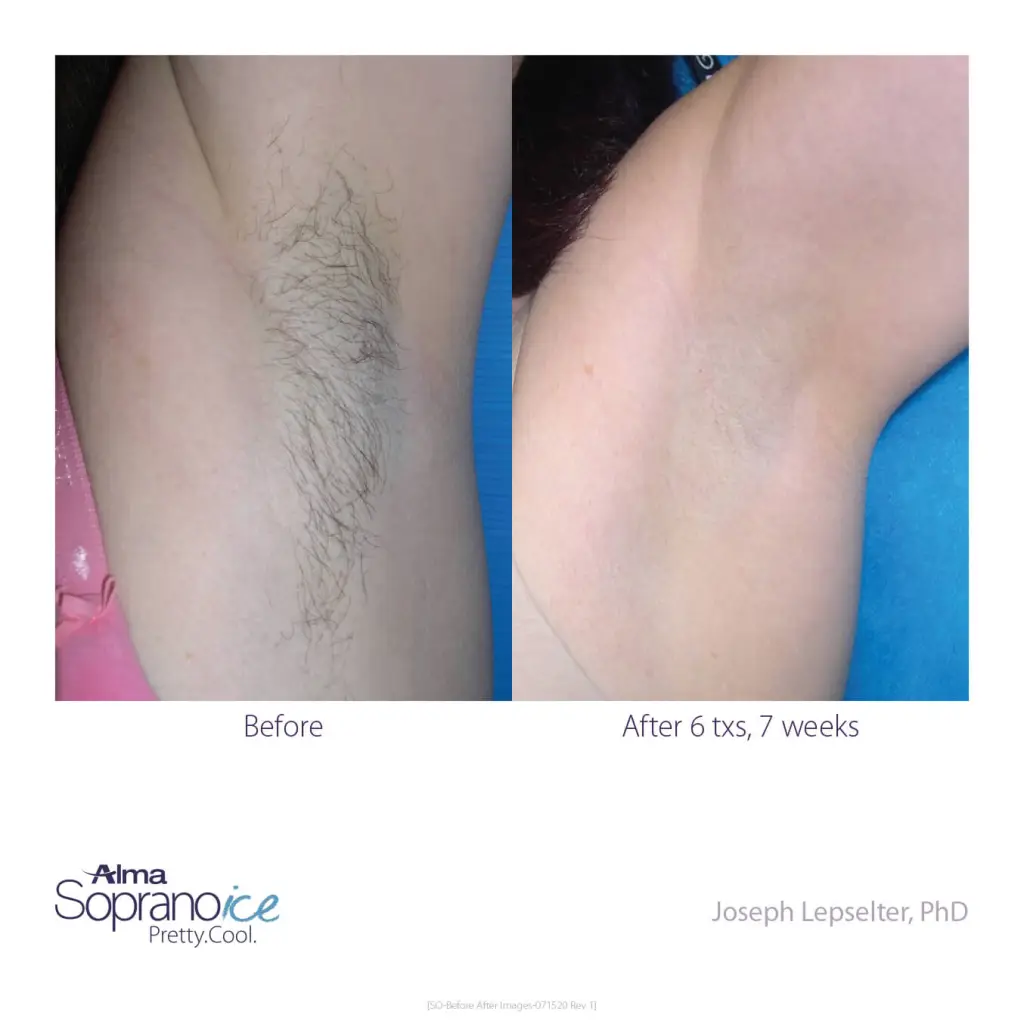 Soprano-ICE-Before-and-After-B2C-7-Hair-Removal