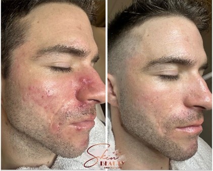 chemical peels