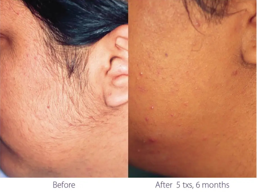 Before and after Laser Hair Removal 