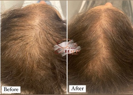 Scalp Needling for Hair Growth
